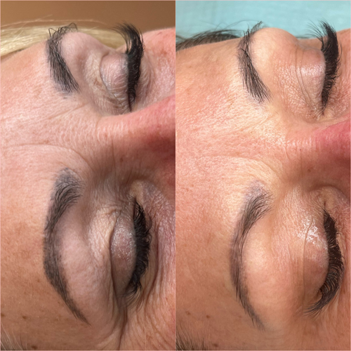 cosmetic tattoo removal before and after
