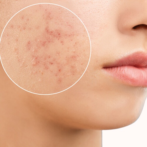 skin with acne